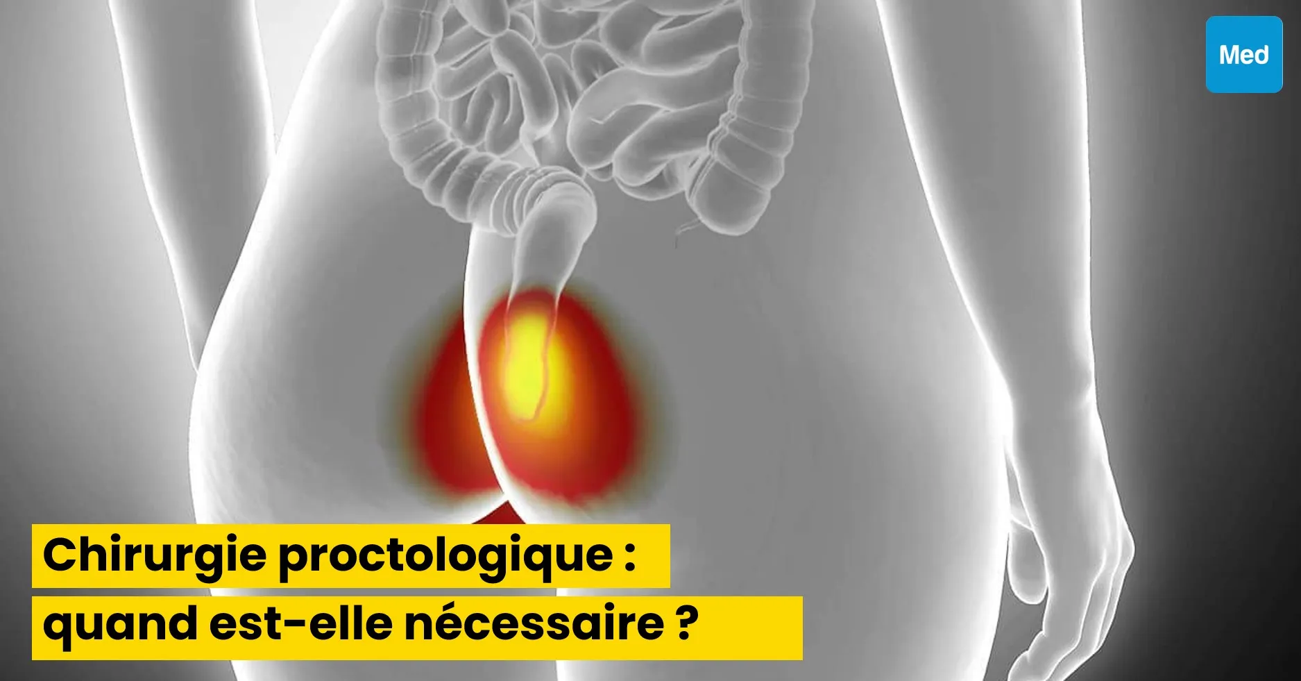 Chirurgie proctologique : quand est-elle nécessaire ?